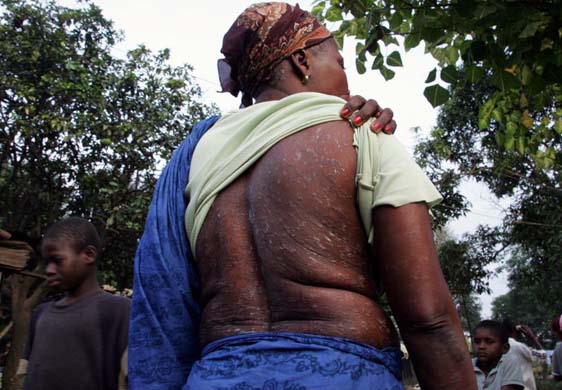 Agbo N'guessan shows her skin problems believed to be caused by toxic waste dumped nearby