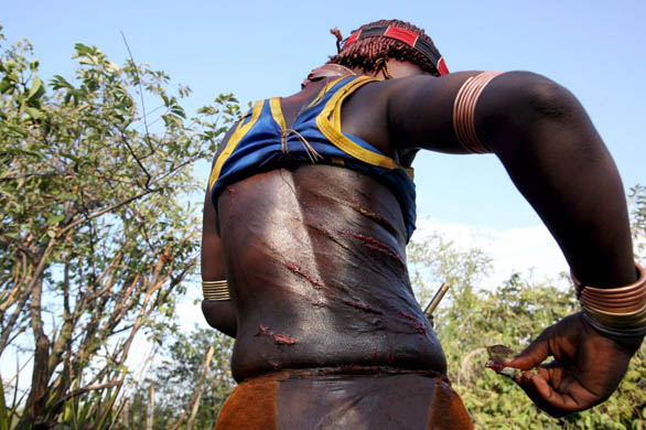 A woman cleans the welts on her back