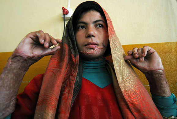 Herat, Afghanistan: Raza Ahmadi shows the burn scars on her face and arms