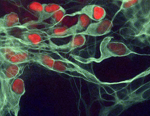 Motor neurons transformed from skin cells of a patient suffering from amyotrophic lateral sclerosis