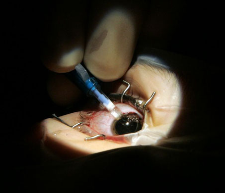 Los Angeles, US: Dr Paul Dougherty inserts a rolled-up intraocular lens implant through a tiny incision in the eye of Megan Garvin