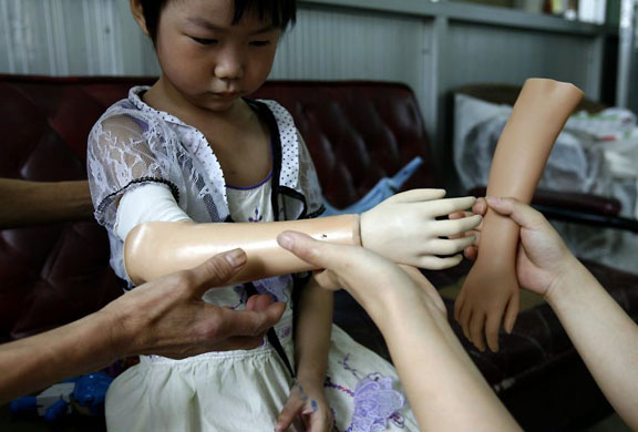 Chengdu, China: Five-year-old Li Yaoyao injured in the Sichuan earthquake has an artificial arm fitted by a doctor at Sichuan Province Orthopedic Centreo