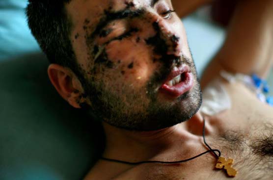 An injured Georgian soldier