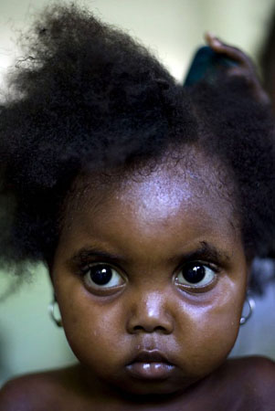 Deschapelles, Haiti: Marie Joselyn, who suffers from malnutrition, waits for attention at the Albert Schweitzer hospital