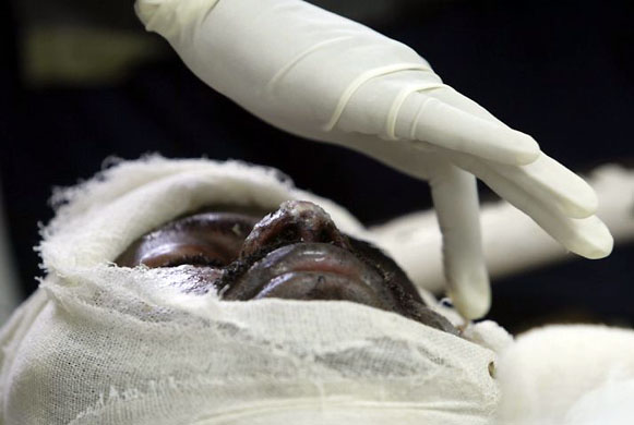 Ahmadabad, India: A relative applies ointment on the burnt face of Sunil Prakash Kakade