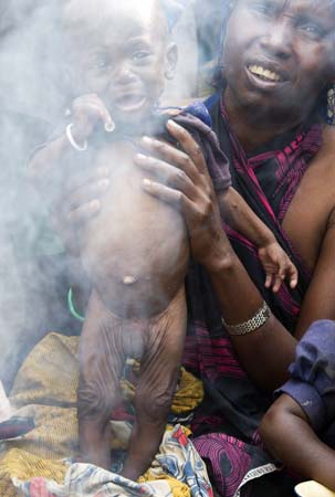 Starving child, Congo