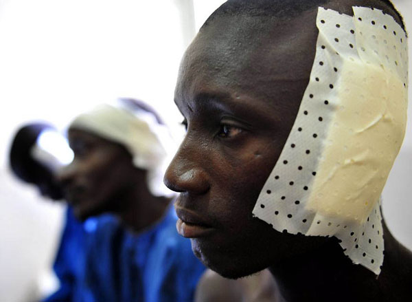 Ziguinchor, Senegal: Three injured people wait for assistance in a hospital