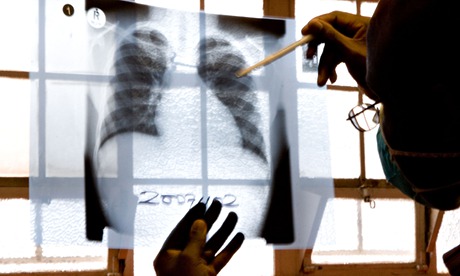 MDG : TB in South Africa : doctor examines chest X-rays at a tuberculosis clinic, Cape Town