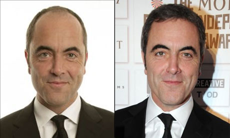 Mopping up? ... James Nesbitt before and after his hair transplant.