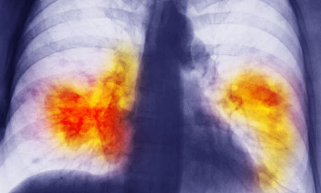 A lung cancer chest x-ray x rays of lung cancer. A lung cancer chest x-ray
