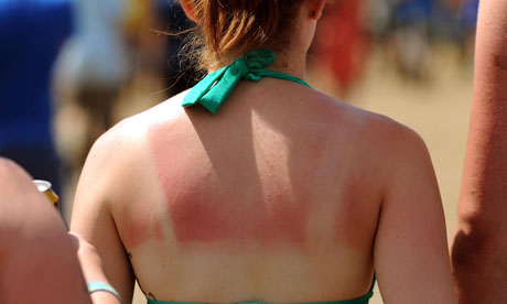 A woman with a sunburnt back