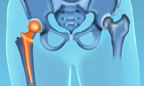 Hip prosthesis