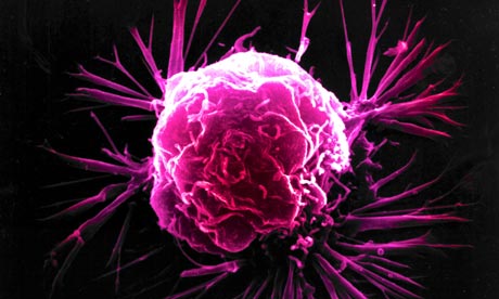 Silencing the speech gene FOXP2 causes breast caNcer cells to metastasize