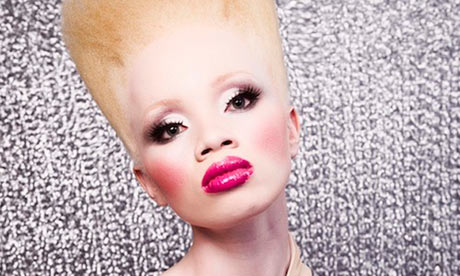 pics of albinism