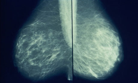 A colour-enhanced mammogram. There is evidence that early diagnosis can raise survival rates.