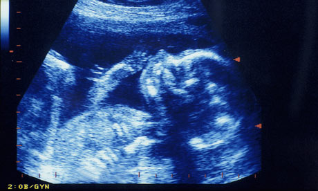 Ultrasound foetus scan