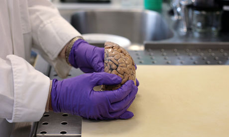 A brain sample at John Radcliffe hospital, Oxford.