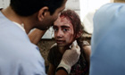 A Syrian girl receives treatment after she was wounded by regime force's helicopter