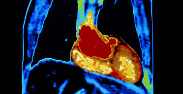 A coloured MRI scan of healthy heart and lungs