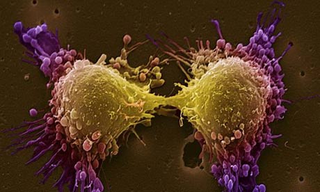 Coloured scanning electron micrograph of two prostate cancer cells in the final stage of cell division