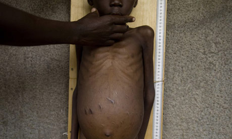 Ugandan boy suffering from malnutrition