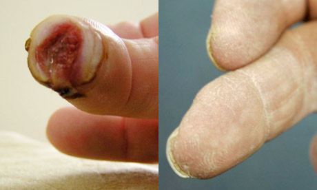 Finger which grew back after'pixie dust' treatment