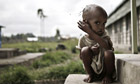 Malnourished Ethiopian boy