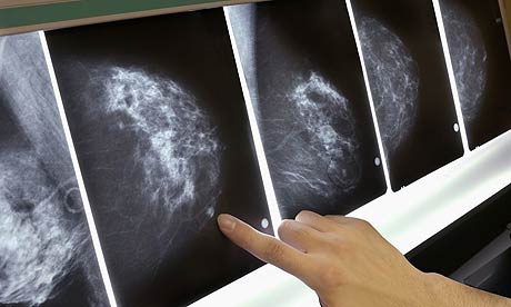A close-up of a mammogram x-