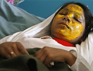 Shamsia, 17, victim of an acid attack by the Taliban, lies on a bed at a hospital in Kabul