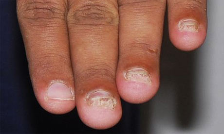 A photograph of Rangzieb Ahmed's hands taken in September 2007, one year after he said his fingernails were removed. Photograph: Greater Manchester police