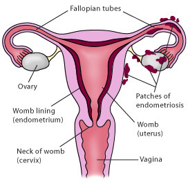 Endometriosis affects parts of your body around your womb. This picture shows the area from the front.