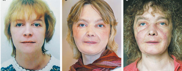 10 years: Isabelle Dinoire