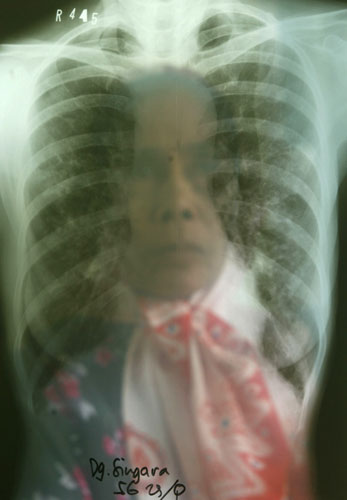 24 hours: A woman with suspected Tuberculosis in Indonesia