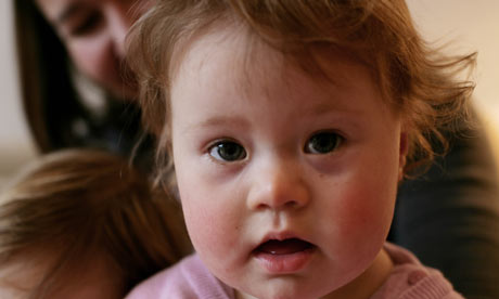 treatments for down syndrome. Down#39;s syndrome case study