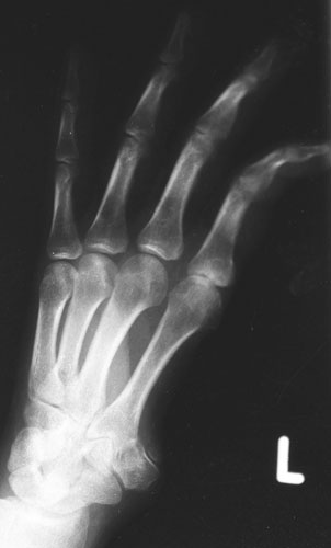 X-rays of torture: Torture x-rays