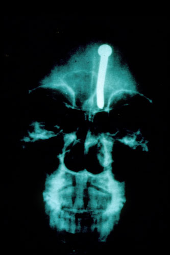 X-rays of torture: Torture x-rays