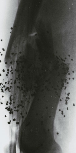 X-rays of torture: Torture x-rays