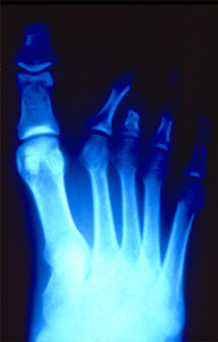 X-rays of torture: Torture x-rays