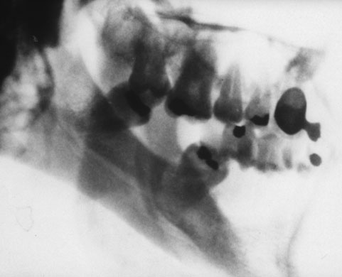 X-rays of torture: Torture x-rays