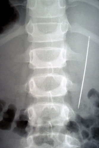 X-rays of torture: Torture x-rays