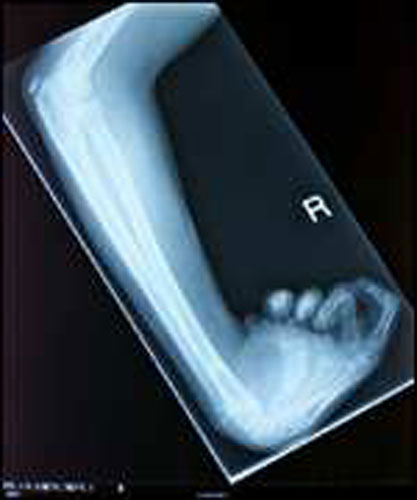 X-rays of torture: Torture x-rays