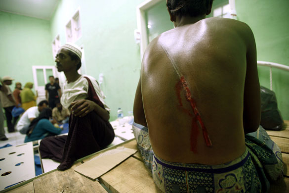Gallery Rohingya refugees: A Rohingya refugee shows the wound on his back 