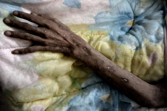Lop Buri, Thailand: A patient with AIDS lies on his bed.