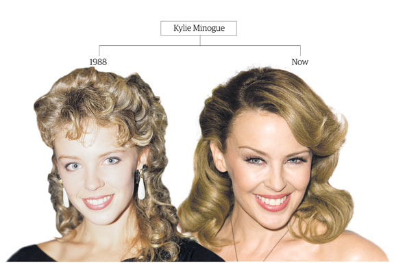 Botox: Kylie Minogue