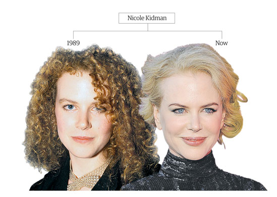 Botox-Nicole-Kidman-005.jpg