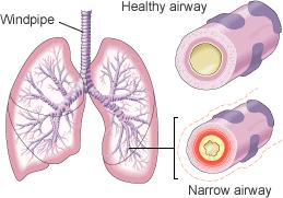 http://static.guim.co.uk/sys-images/Guardian/Pix/pictures/2009/5/1/1241151707556/asthma-airways-uk_default.jpg