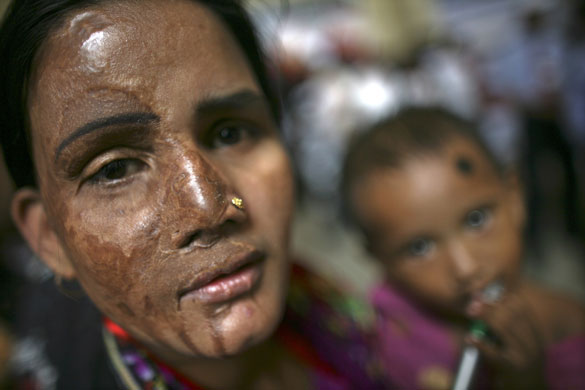 12 May 2009: Dhaka, Bangladesh: A survivor of an acid attack attends a rally