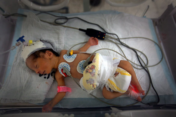 29 May 2009: Gaza City, Gaza Strip: A child undergoes therapy in the intensive care unit
