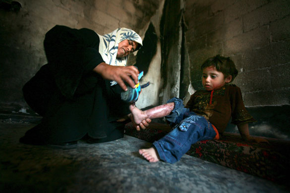 6 May 2009: Gaza: A woman puts shoes on the scarred legs of her four year old son Ali