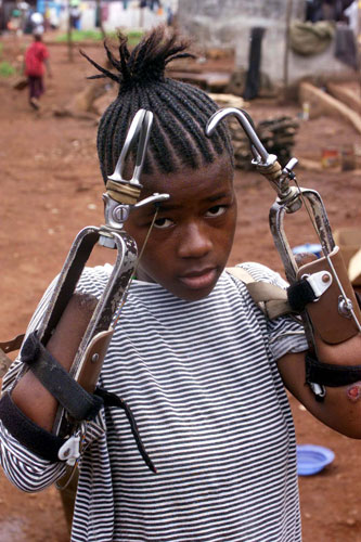 Charles Taylor: 2000: Fourteen year old shows her artificial limbs in the Amputee camp